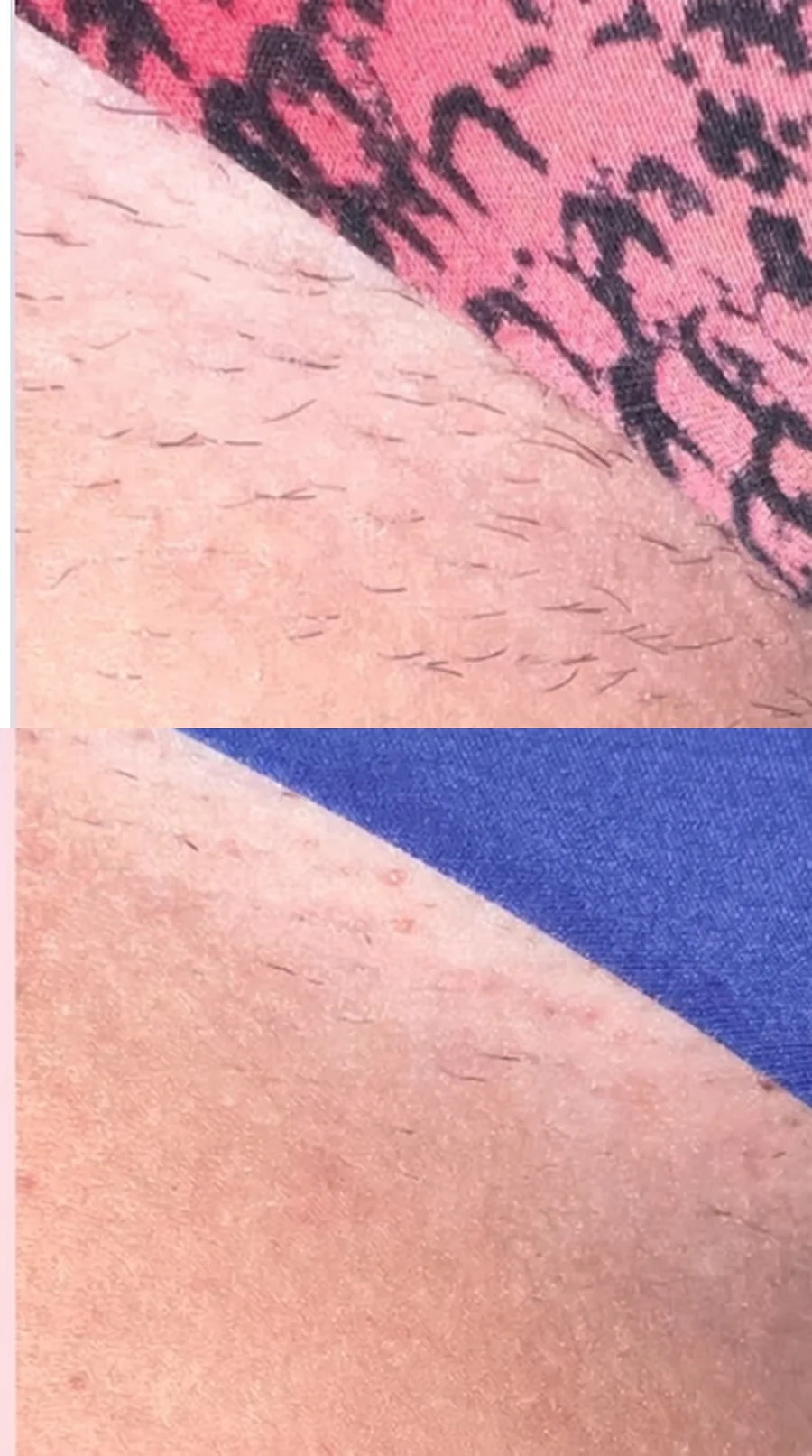 Zona bikini con rutina de cuidado